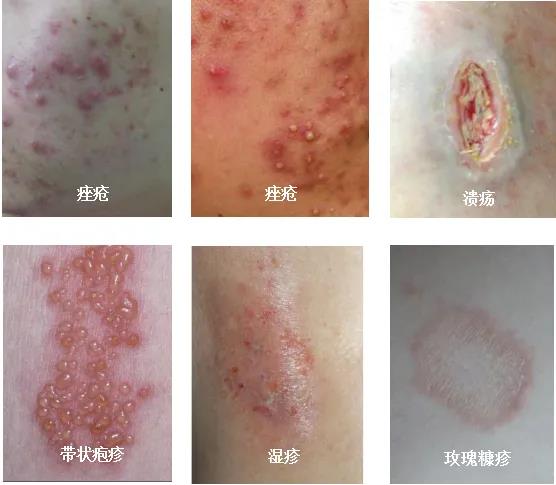 威尼斯vns08866皮肤科引进红蓝光治疗仪和二氧化碳激光治疗仪